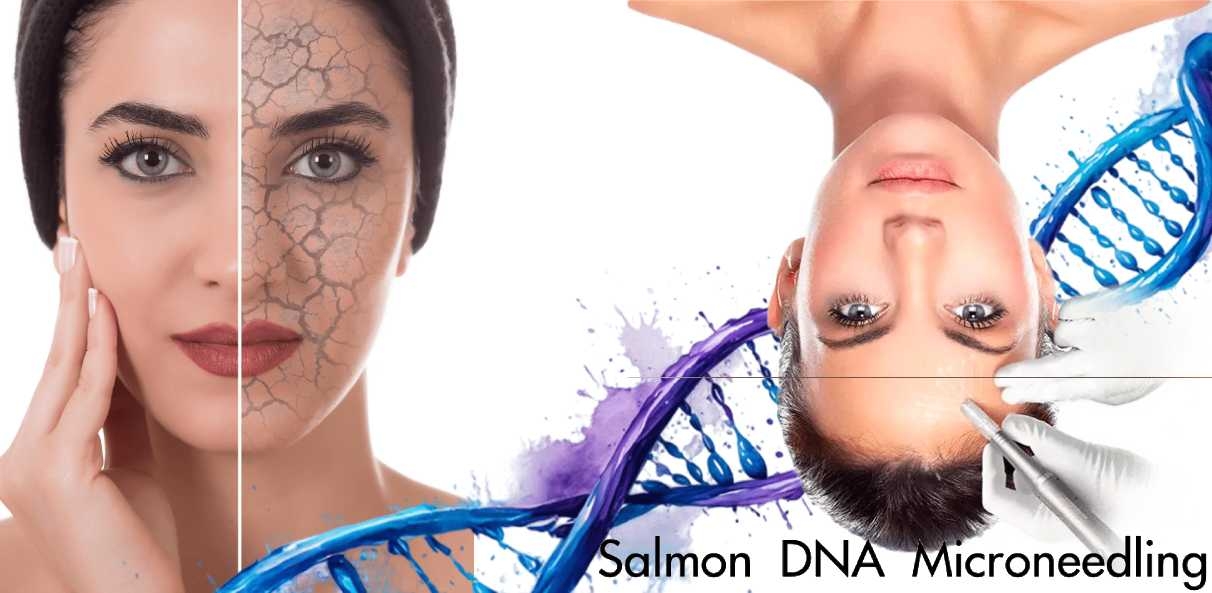 Επαγγελματική Μεσοθεραπεία στο Σπίτι